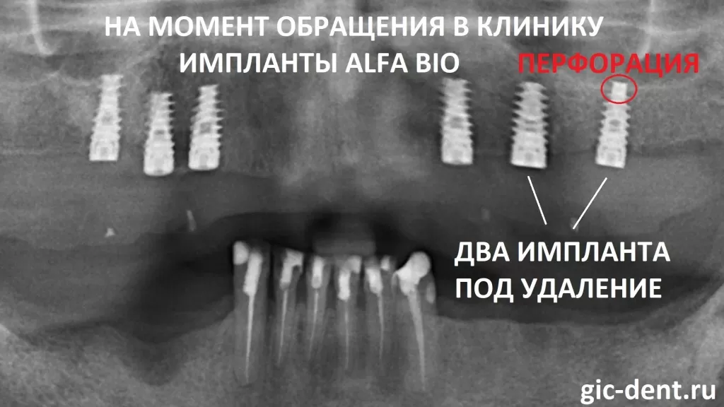 в области установленных ранее на верхней челюсти импланты Alfa Bio, слева, есть перфорации и свищевые ходы. Лечащий врач - хирург, имплантолог Магомед Дахкильгов
